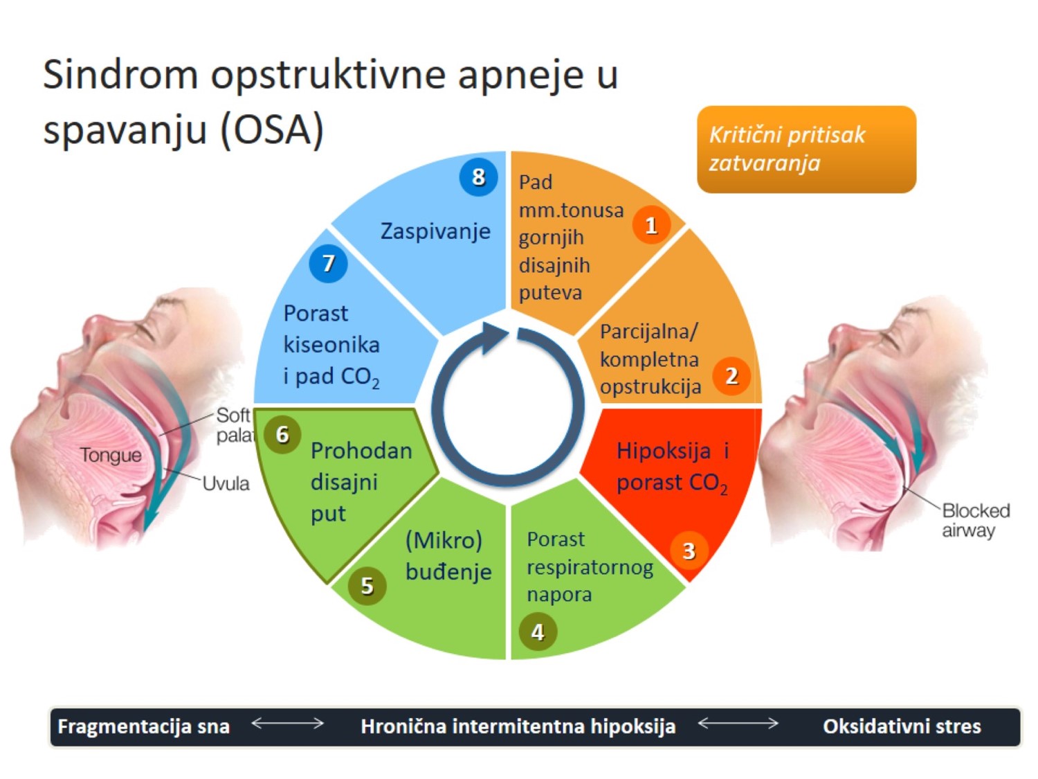 Infografika: ciklus opstruktivne apneje u spavanju — zaspivanje, pad tonusa mišića gornjih disajnih puteva, parcijalna ili kompletna opstrukcija, hipoksija i porast CO2, porast respiratornog napora, mikrobuđenje, prohodan disajni put i porast kiseonika; fragmentacija sna, hronična intermitentna hipoksija i oksidativni stres